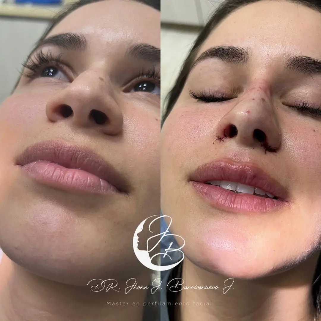 Alectomía Alectomía