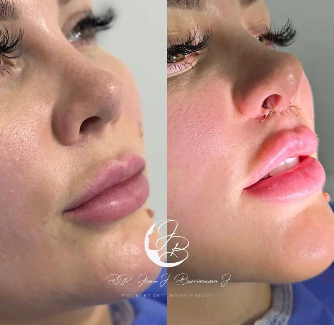 Lifting de Labio Lifting de Labio