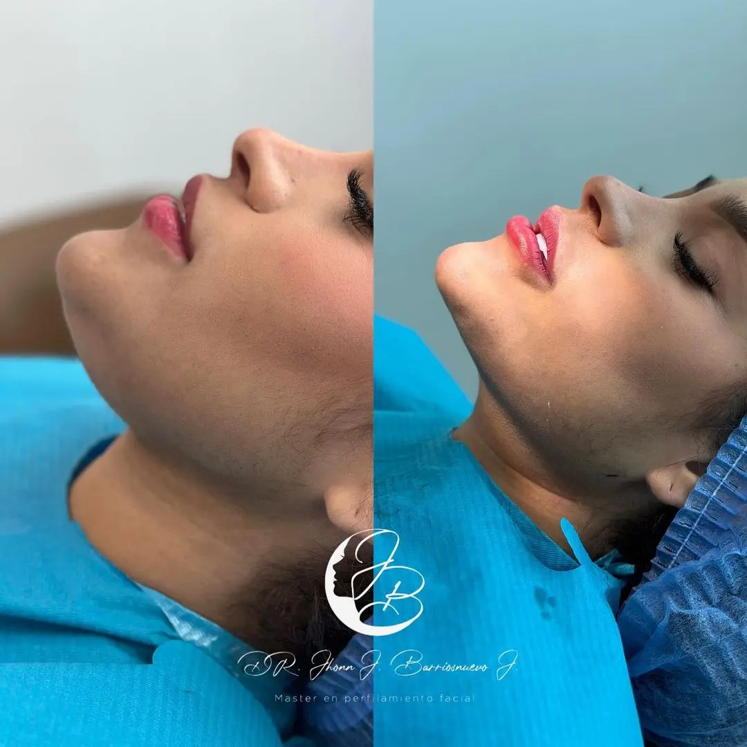 Lipolaser de Papada Lipolaser de Papada