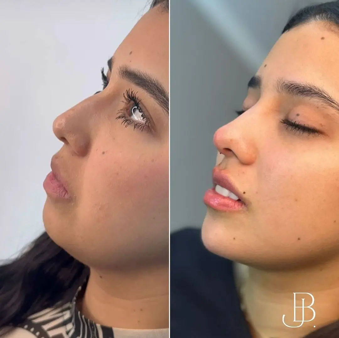 Rinomodelación Rinomodelación